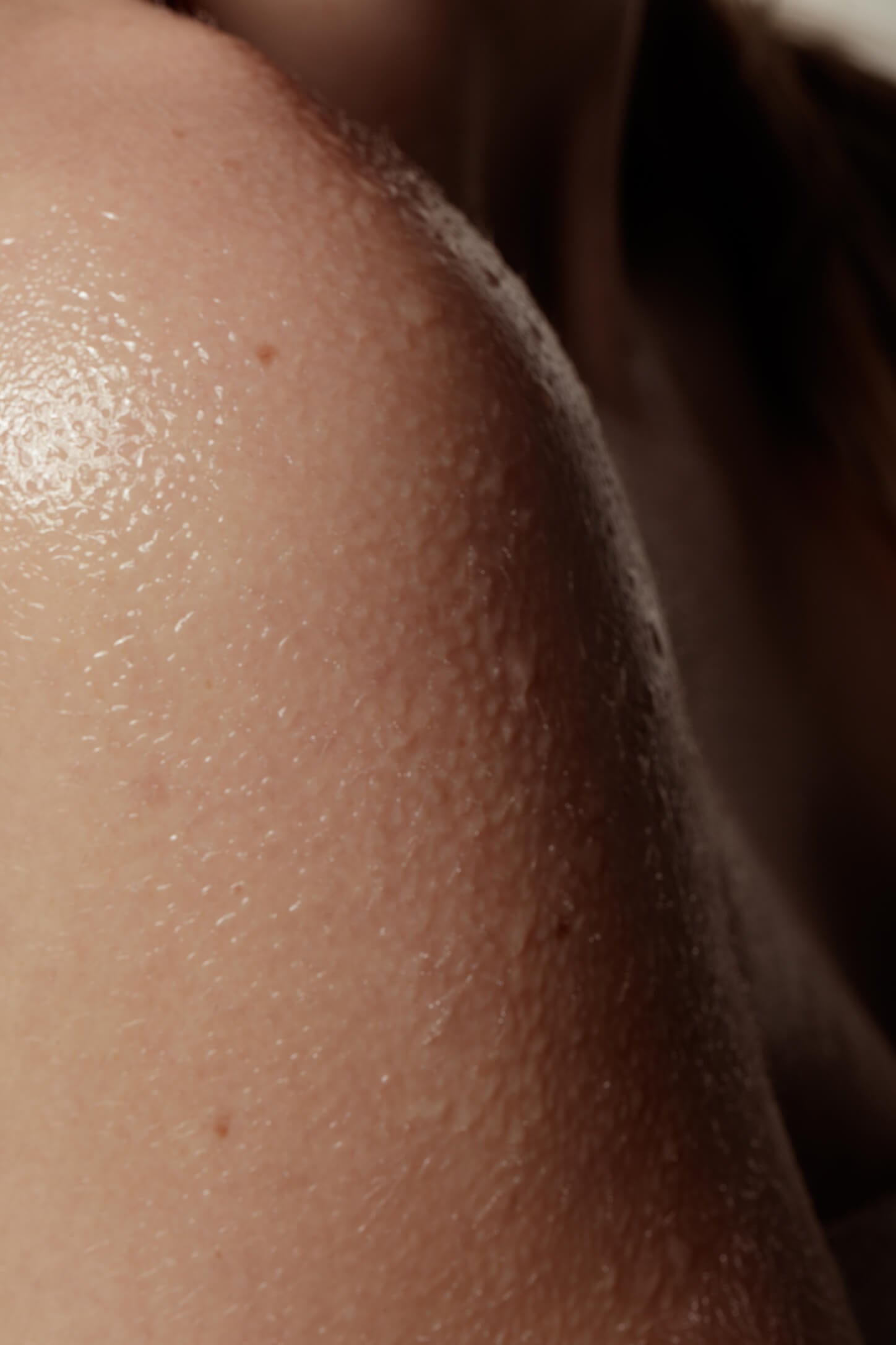 Wat is een vette huid?